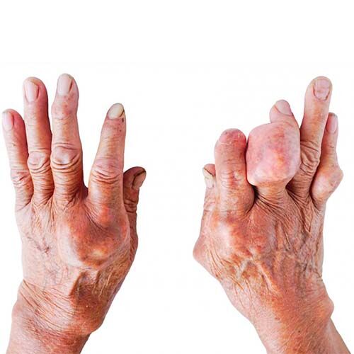 cigarette smoking and diabetes The Dangerous Combination of Smoking, Diabetes, and Non-Healing Wounds cigarette smoking and diabetes The Dangerous Combination of Smoking, Diabetes, and Non-Healing Wounds